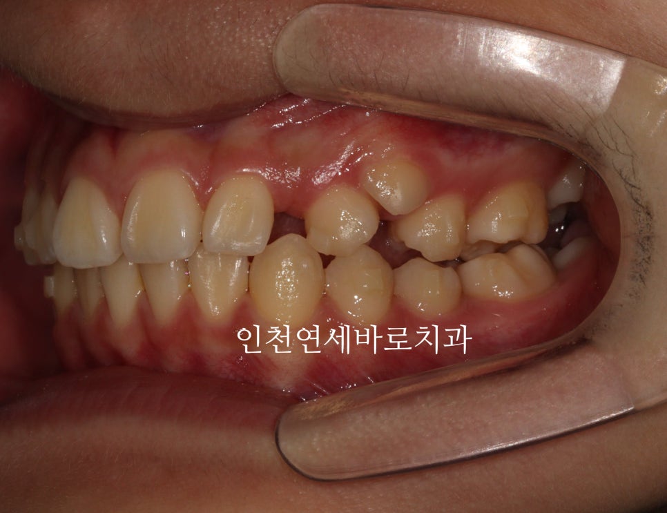 인비절라인 치료 치아 위치 이상 23년 11월~ 24년 10월 기록