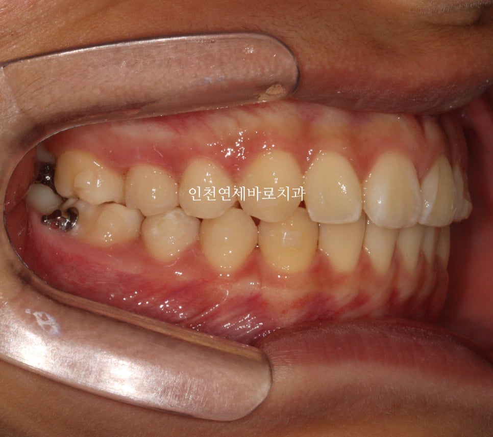 인비절라인 치료 치아 위치 이상 23년 11월~ 24년 10월 기록