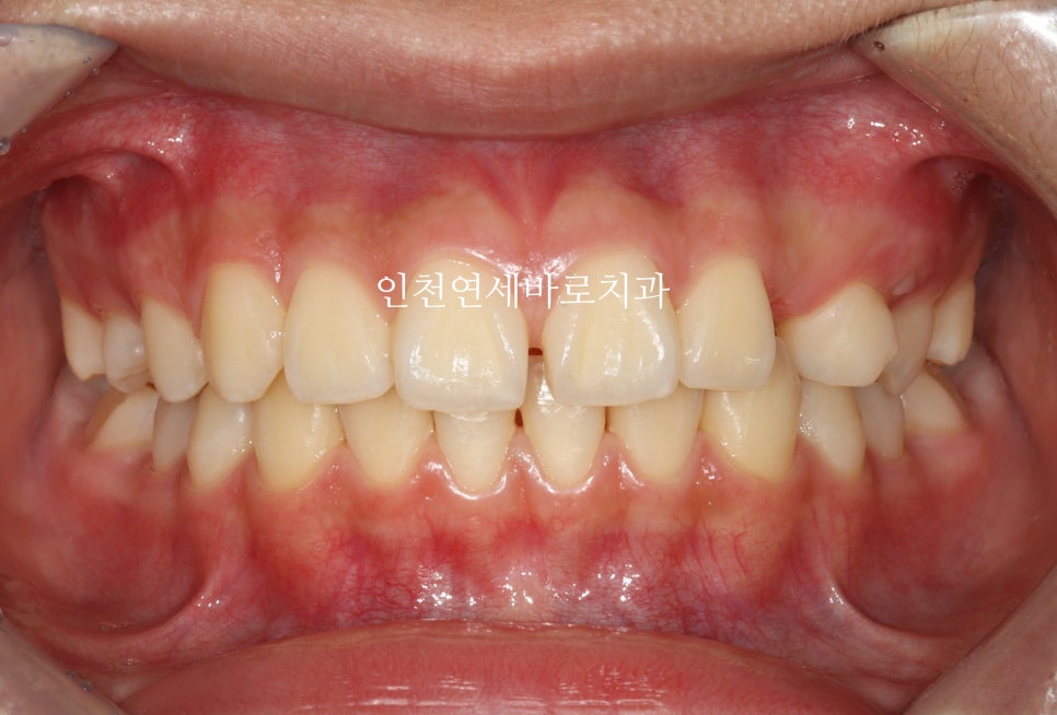 인비절라인 치료 치아 위치 이상 23년 11월~ 24년 10월 기록