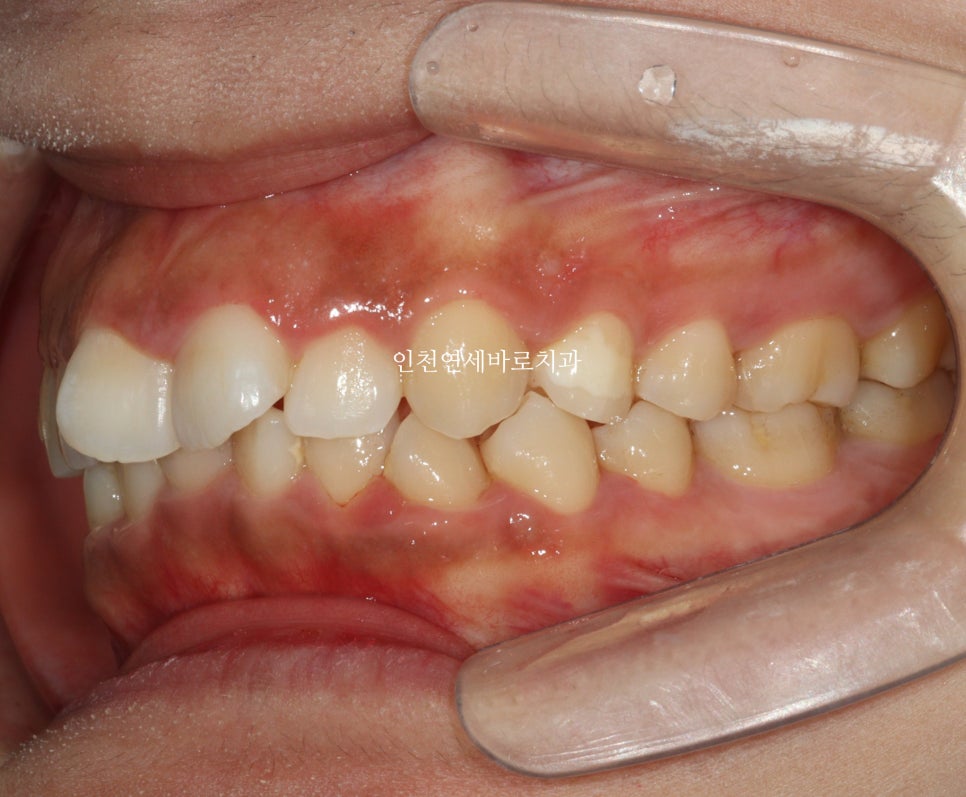 인비절라인 라이트 투명교정. 24년에 시작~24년에 끝