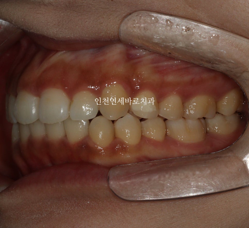 인비절라인 라이트 투명교정. 24년에 시작~24년에 끝