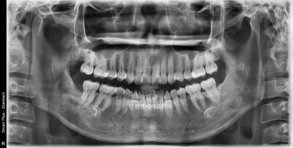 인비절라인 라이트 투명교정. 24년에 시작~24년에 끝