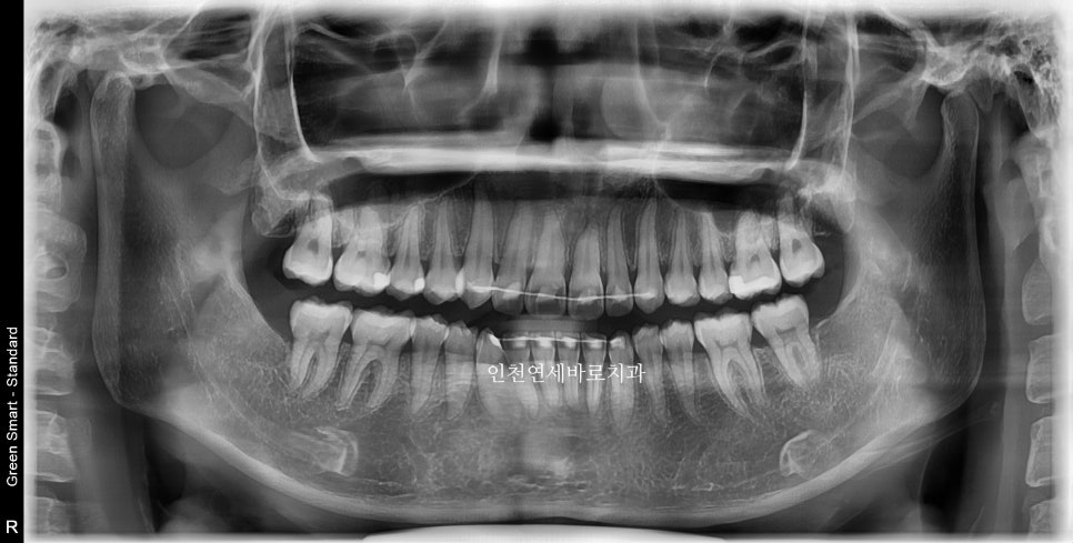 인비절라인 라이트 투명교정. 24년에 시작~24년에 끝