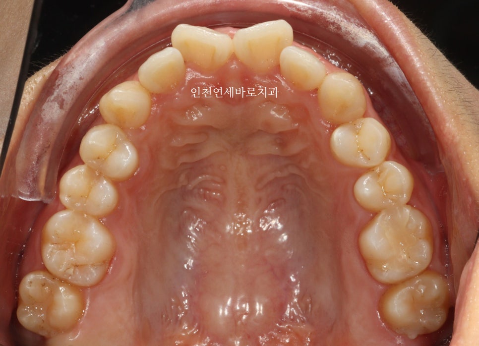 인비절라인 라이트 투명교정. 24년에 시작~24년에 끝