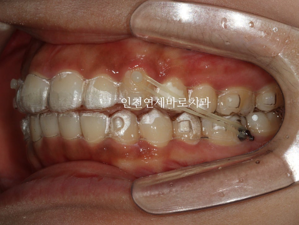 인비절라인 라이트 투명교정. 24년에 시작~24년에 끝