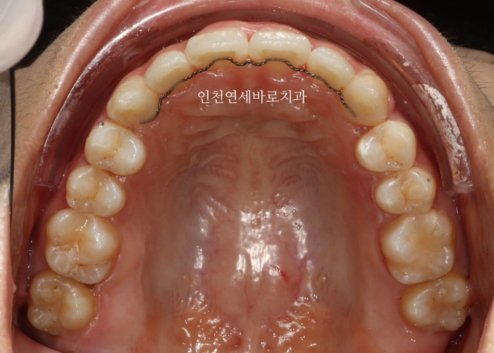 인비절라인 라이트 투명교정. 24년에 시작~24년에 끝