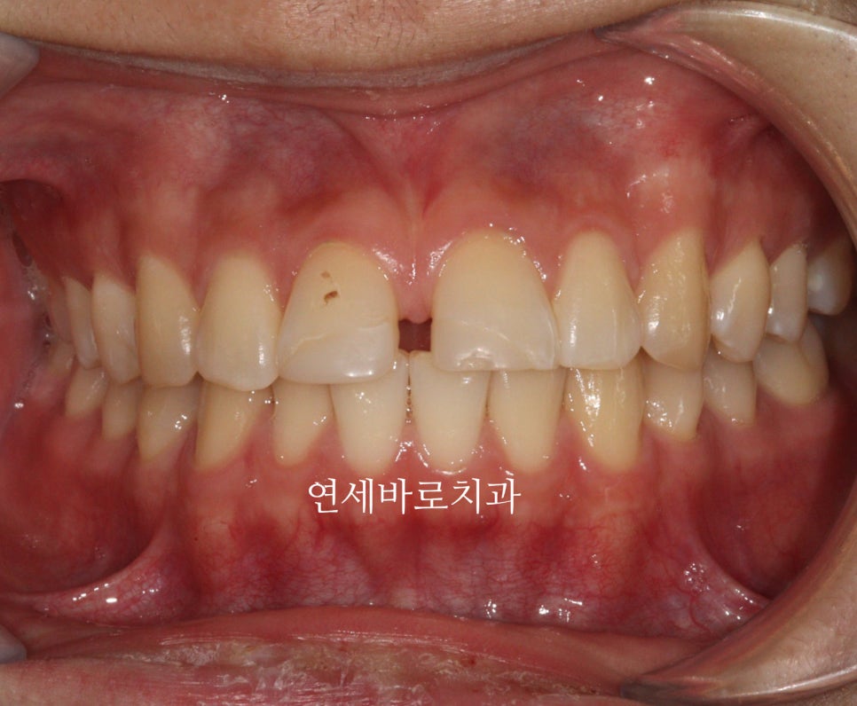 벌어진 치아는 절대 레진, 라미네이트 하지마세요. 14주만 투자하세요.