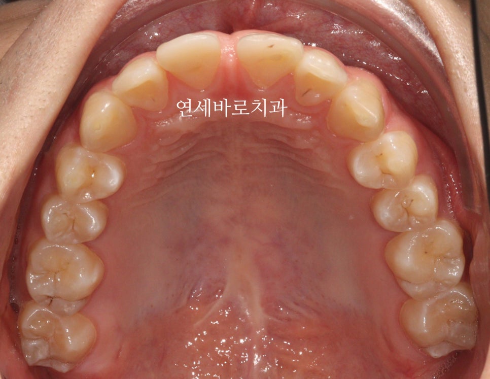 벌어진 치아는 절대 레진, 라미네이트 하지마세요. 14주만 투자하세요.