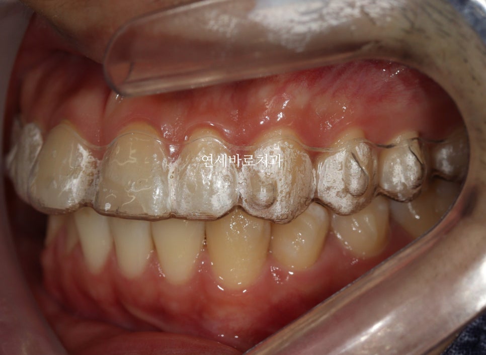 벌어진 치아는 절대 레진, 라미네이트 하지마세요. 14주만 투자하세요.