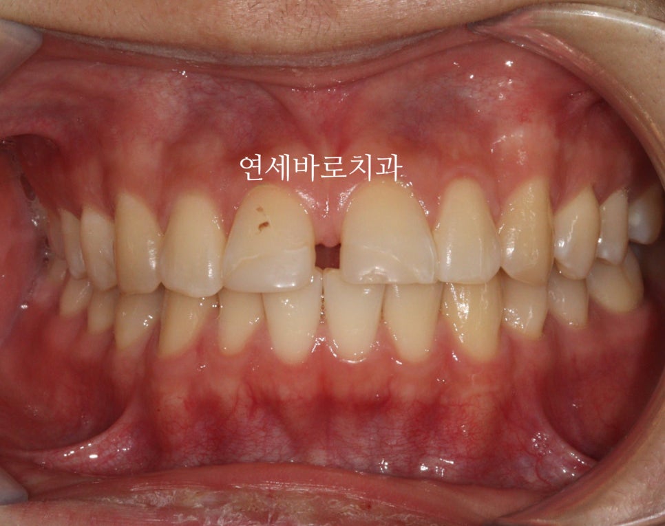 벌어진 치아는 절대 레진, 라미네이트 하지마세요. 14주만 투자하세요.