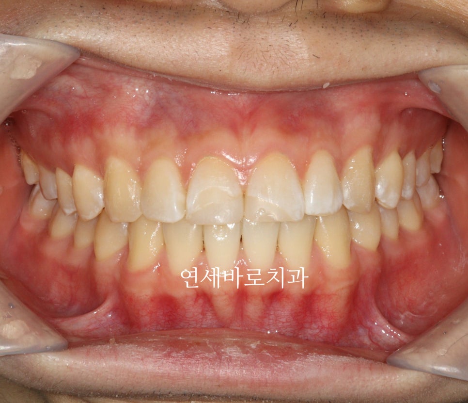 벌어진 치아는 절대 레진, 라미네이트 하지마세요. 14주만 투자하세요.