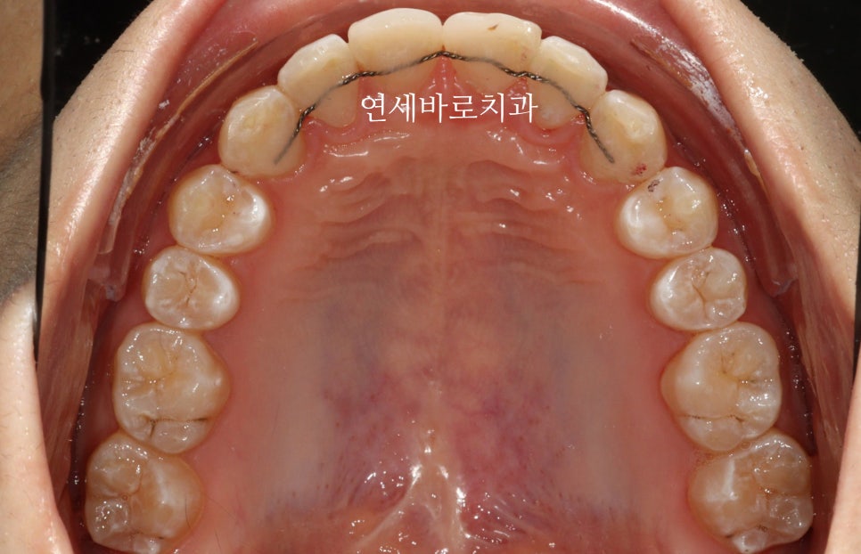 벌어진 치아는 절대 레진, 라미네이트 하지마세요. 14주만 투자하세요.