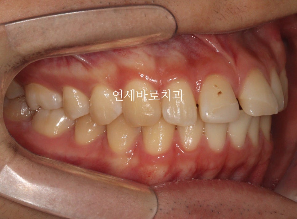벌어진 치아는 절대 레진, 라미네이트 하지마세요. 14주만 투자하세요.