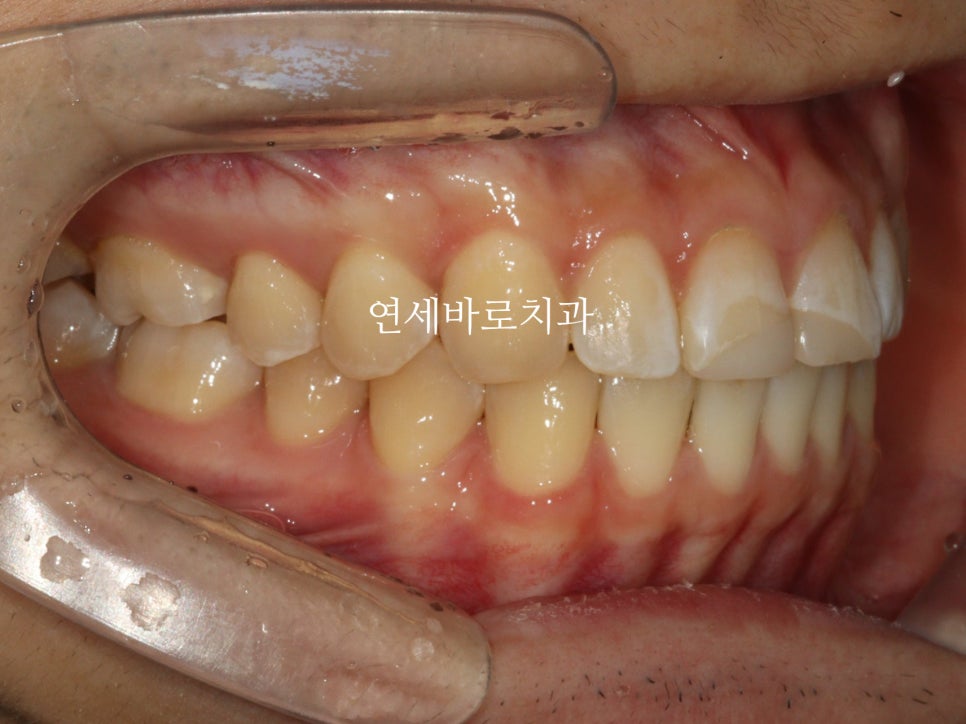벌어진 치아는 절대 레진, 라미네이트 하지마세요. 14주만 투자하세요.