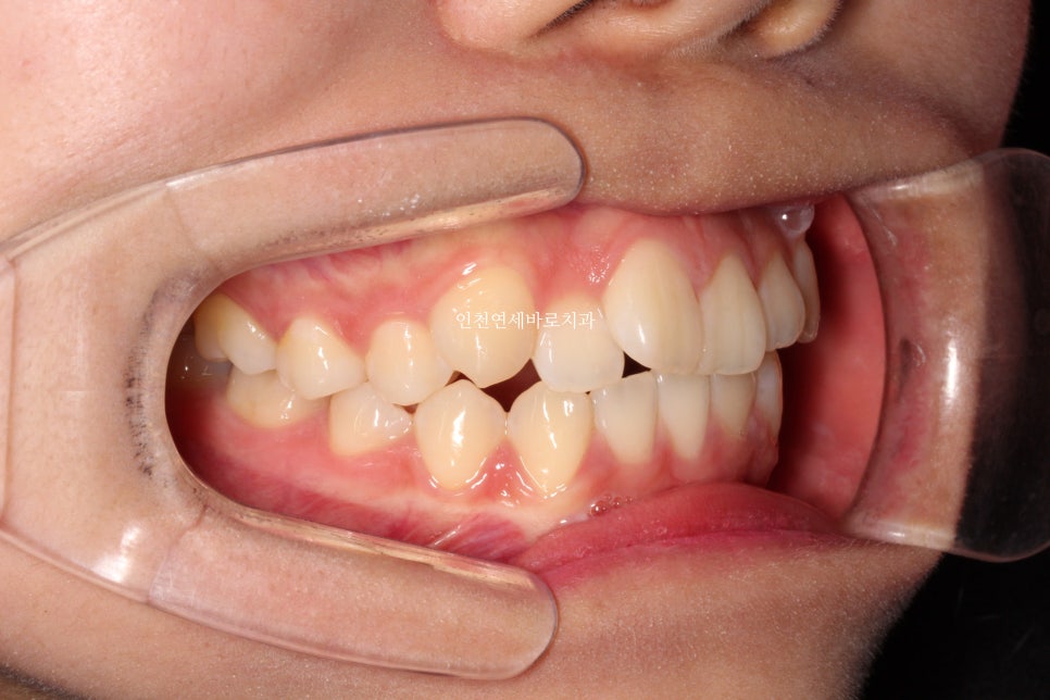 아래 앞니 결손, 투명교정 인비절라인 미니스크류 이용 치료 후기 기록