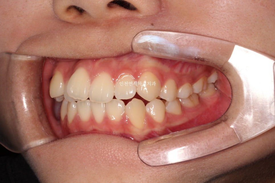 아래 앞니 결손, 투명교정 인비절라인 미니스크류 이용 치료 후기 기록