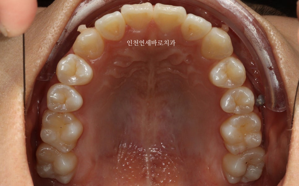 아래 앞니 결손, 투명교정 인비절라인 미니스크류 이용 치료 후기 기록