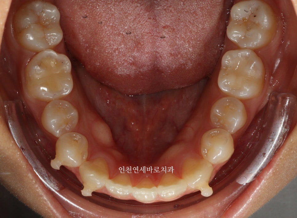 아래 앞니 결손, 투명교정 인비절라인 미니스크류 이용 치료 후기 기록