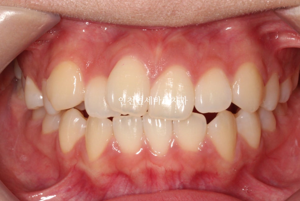 아래 앞니 결손, 투명교정 인비절라인 미니스크류 이용 치료 후기 기록