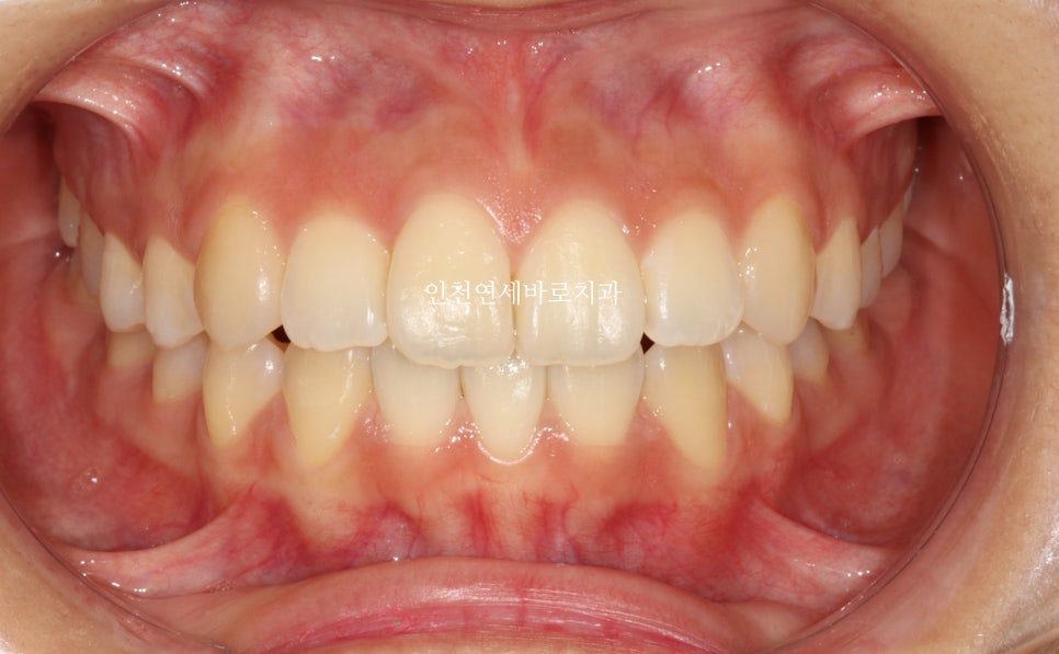 아래 앞니 결손, 투명교정 인비절라인 미니스크류 이용 치료 후기 기록