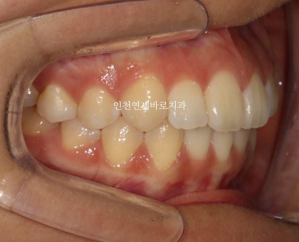 아래 앞니 결손, 투명교정 인비절라인 미니스크류 이용 치료 후기 기록