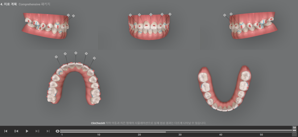 아래 앞니 결손, 투명교정 인비절라인 미니스크류 이용 치료 후기 기록