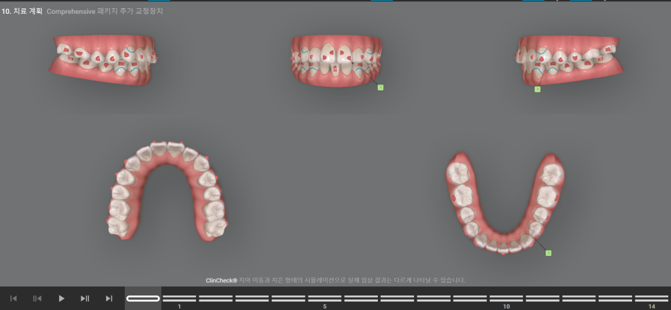 아래 앞니 결손, 투명교정 인비절라인 미니스크류 이용 치료 후기 기록