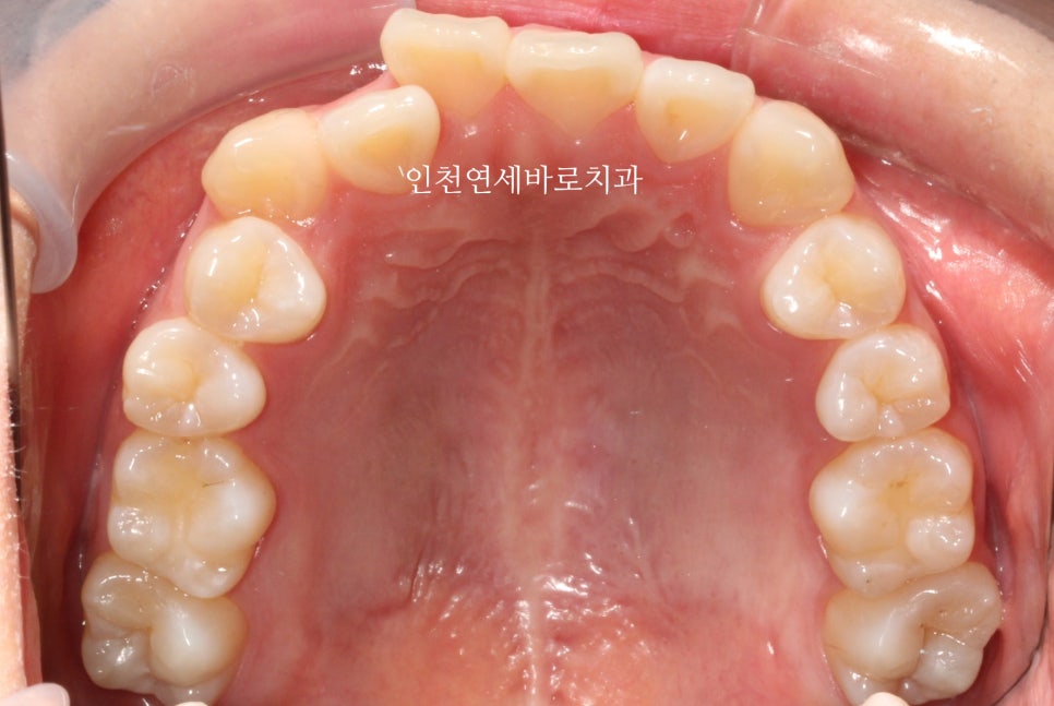 아래 앞니 결손, 투명교정 인비절라인 미니스크류 이용 치료 후기 기록