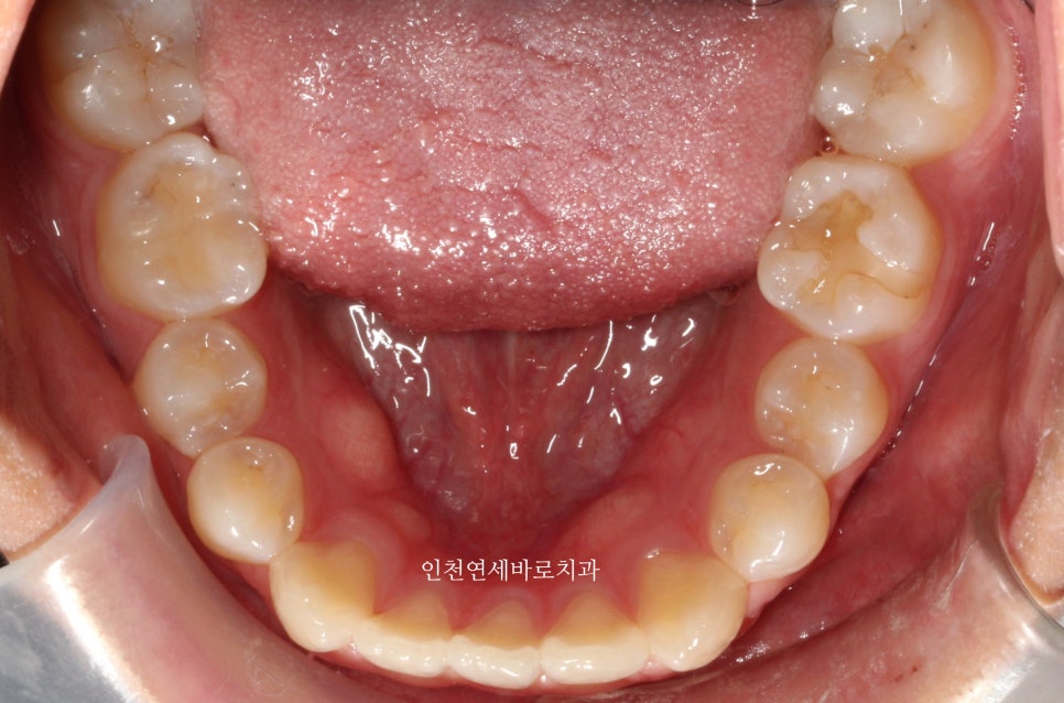 아래 앞니 결손, 투명교정 인비절라인 미니스크류 이용 치료 후기 기록