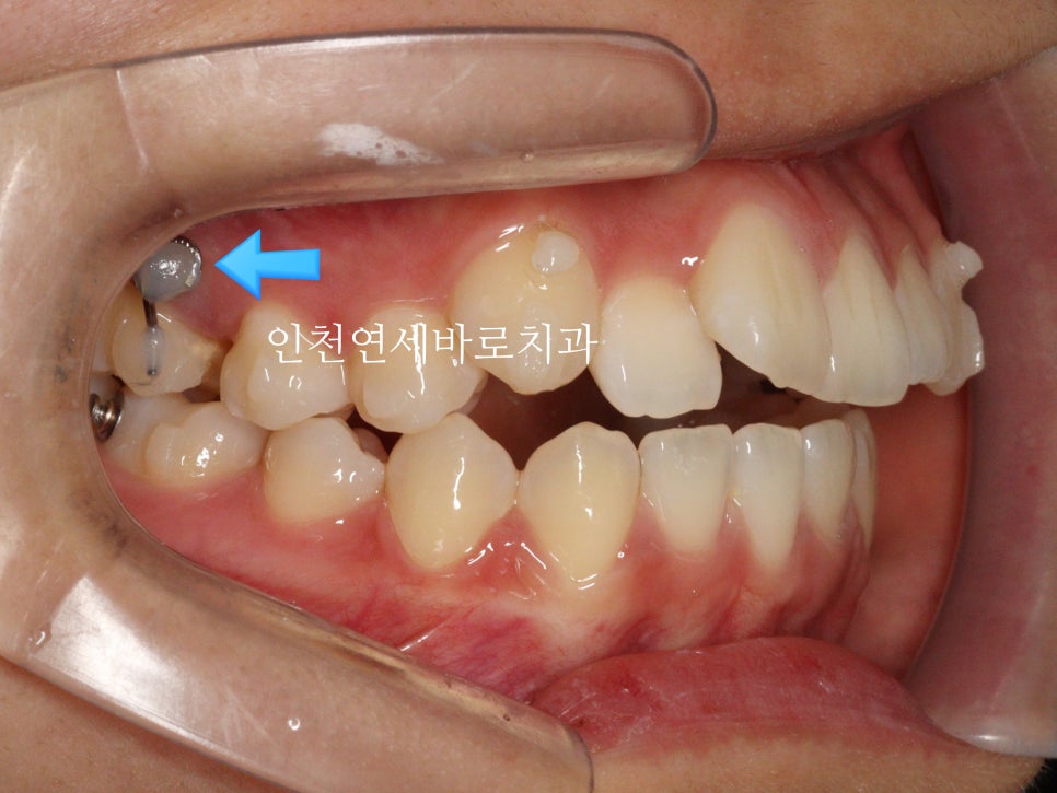 아래 앞니 결손, 투명교정 인비절라인 미니스크류 이용 치료 후기 기록
