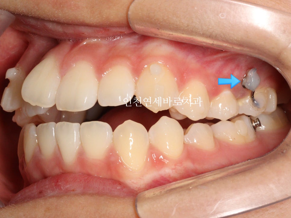 아래 앞니 결손, 투명교정 인비절라인 미니스크류 이용 치료 후기 기록