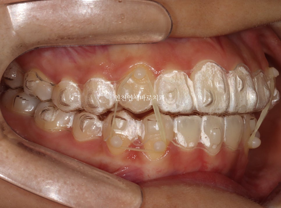 아래 앞니 결손, 투명교정 인비절라인 미니스크류 이용 치료 후기 기록