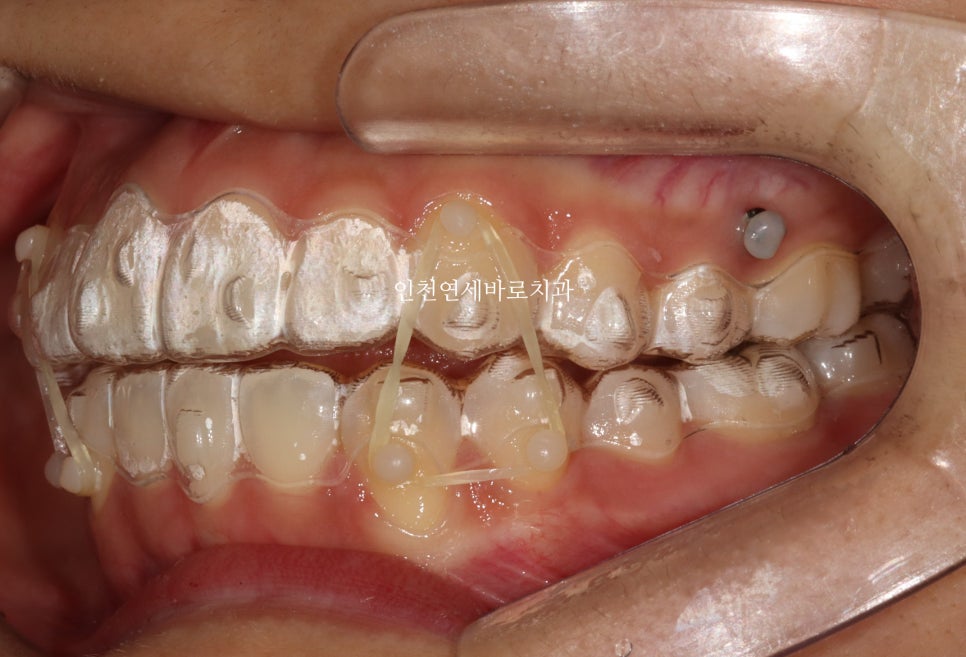 아래 앞니 결손, 투명교정 인비절라인 미니스크류 이용 치료 후기 기록