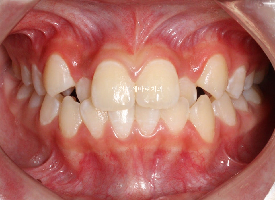 인비절라인 비발치 덧니 교정치료 후기 전후 비교