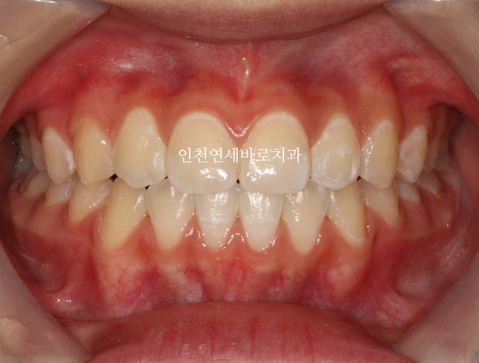 인비절라인 비발치 덧니 교정치료 후기 전후 비교