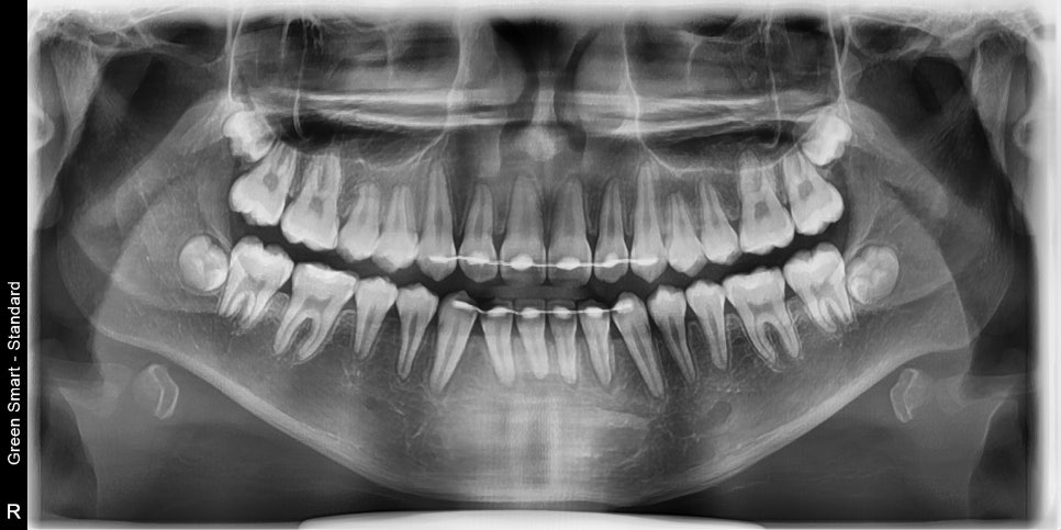 인비절라인 비발치 덧니 교정치료 후기 전후 비교