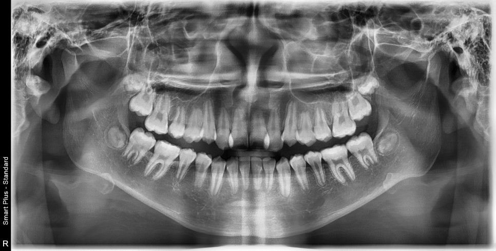 인비절라인 비발치 덧니 교정치료 후기 전후 비교