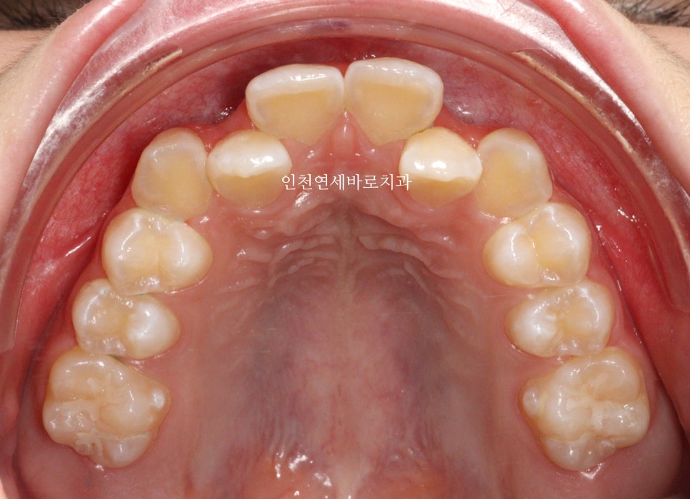 인비절라인 비발치 덧니 교정치료 후기 전후 비교