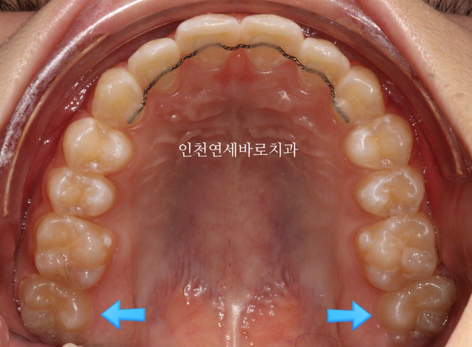 인비절라인 비발치 덧니 교정치료 후기 전후 비교