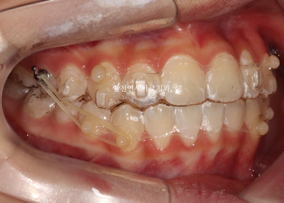 인비절라인 비발치 덧니 교정치료 후기 전후 비교