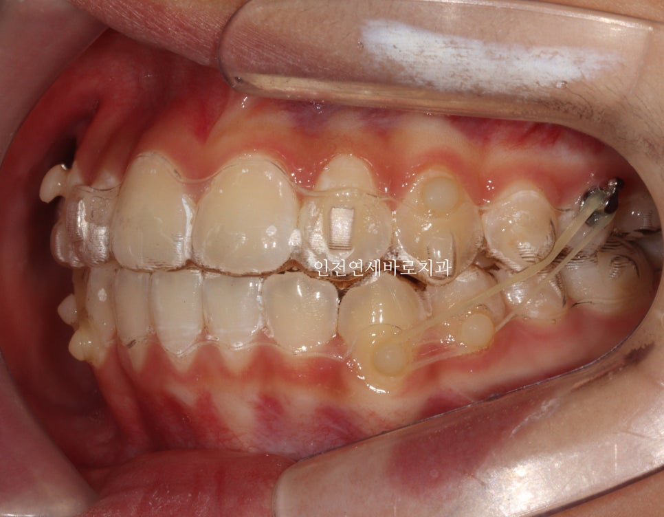 인비절라인 비발치 덧니 교정치료 후기 전후 비교