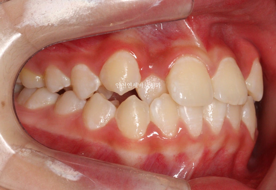 인비절라인 비발치 덧니 교정치료 후기 전후 비교