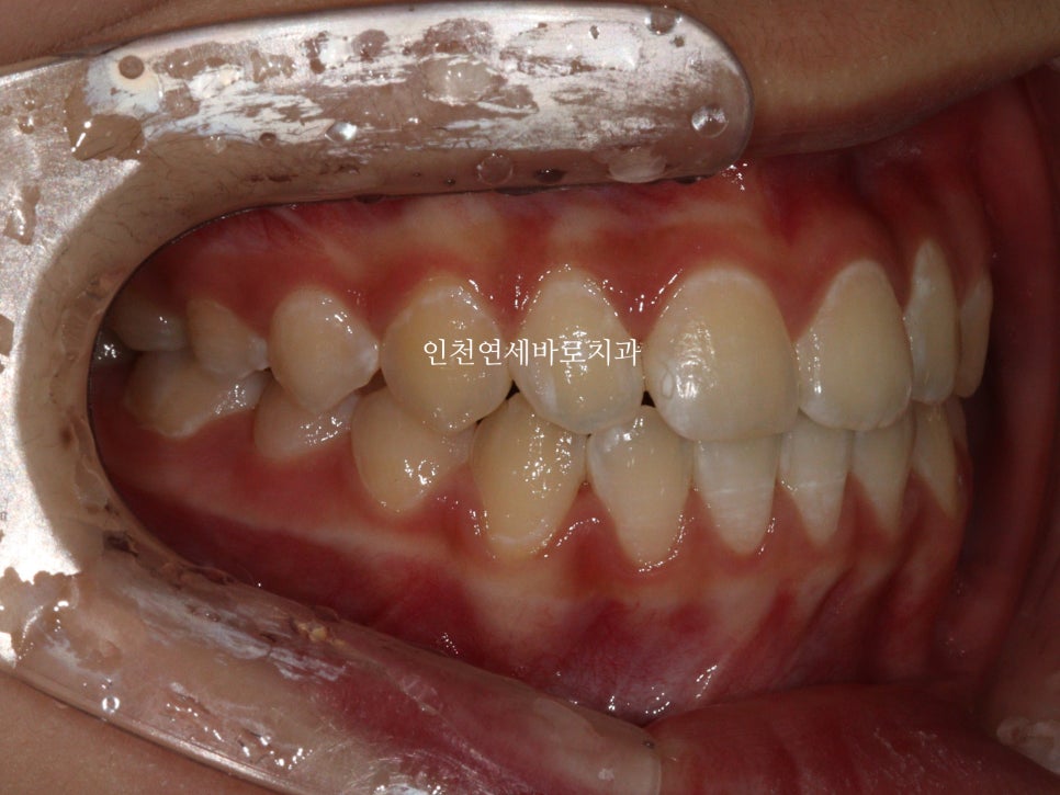 인비절라인 비발치 덧니 교정치료 후기 전후 비교