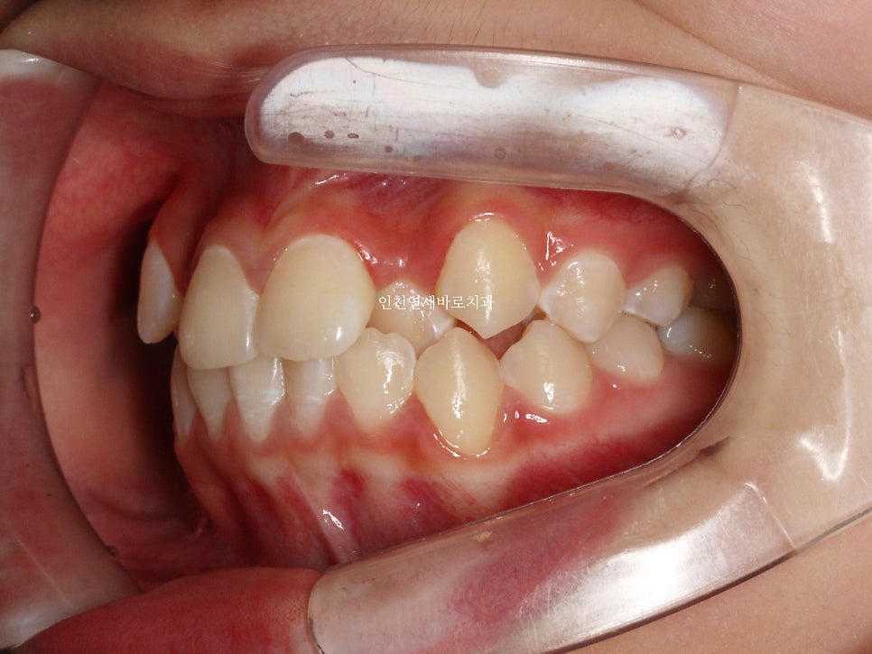 인비절라인 비발치 덧니 교정치료 후기 전후 비교