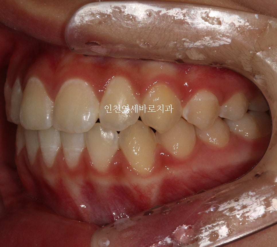 인비절라인 비발치 덧니 교정치료 후기 전후 비교