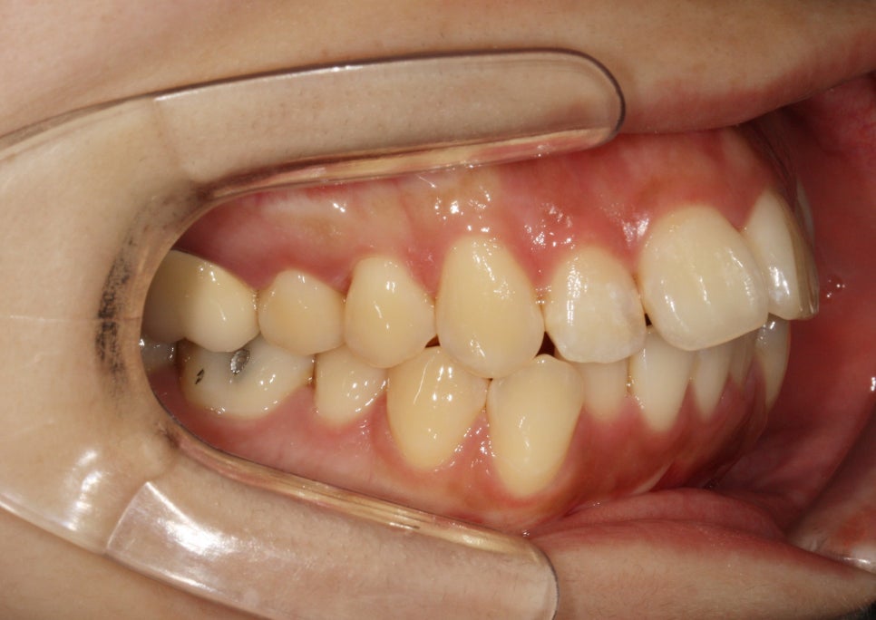 인비절라인 돌출입 발치교정치료