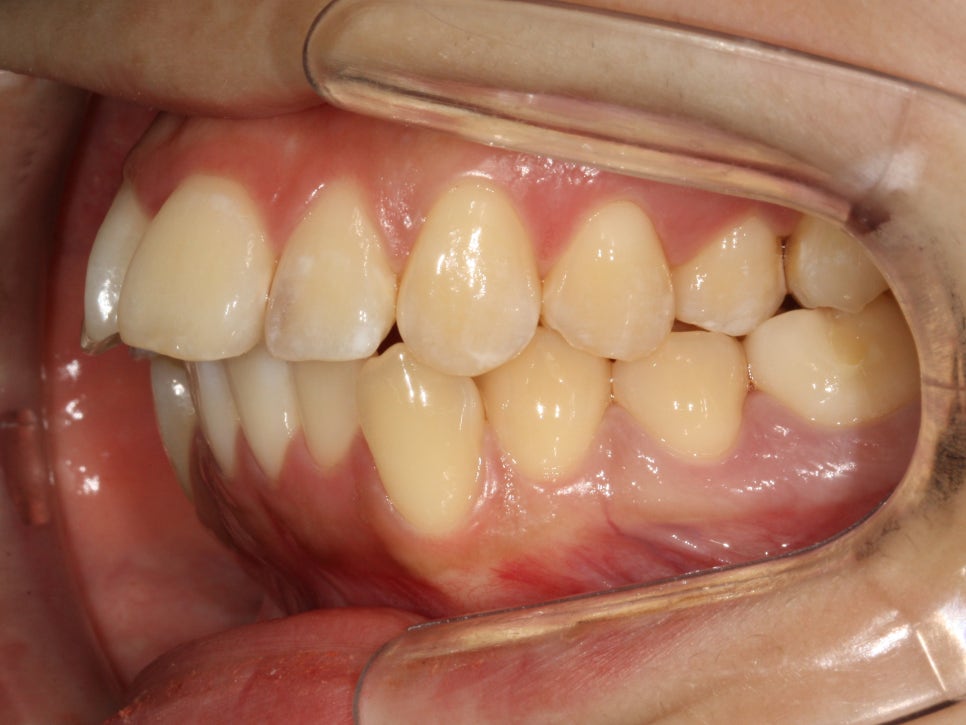 인비절라인 돌출입 발치교정치료