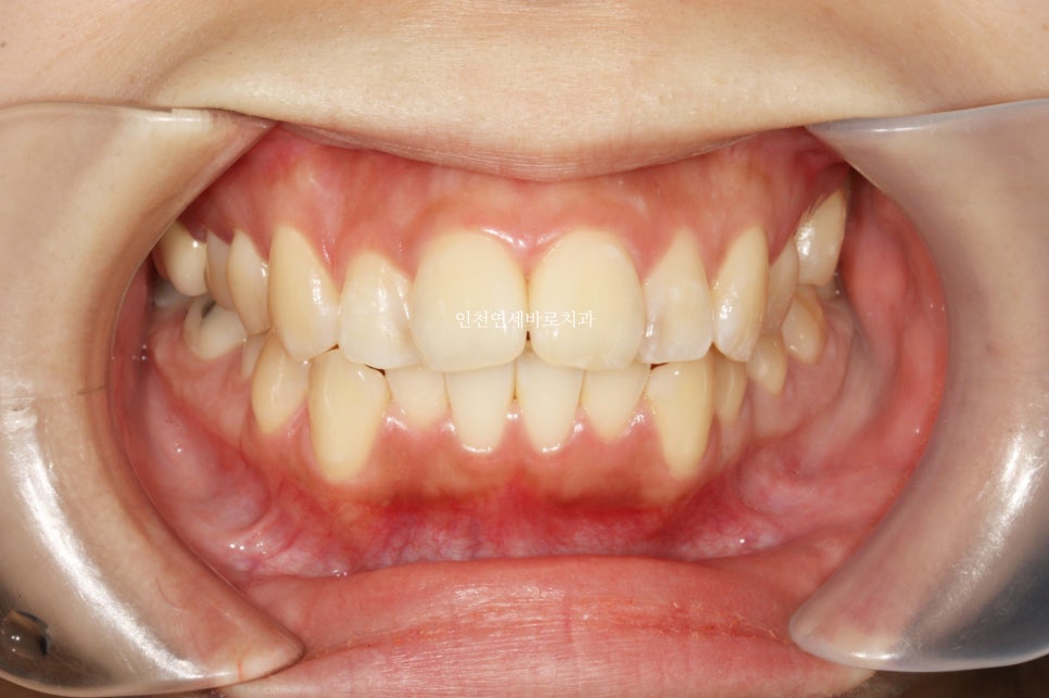 인비절라인 돌출입 발치교정치료