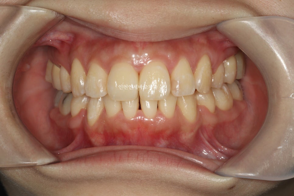 인비절라인 돌출입 발치교정치료