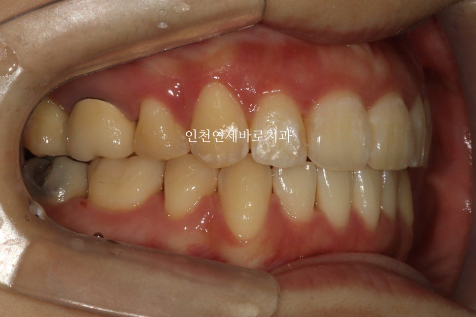 인비절라인 돌출입 발치교정치료